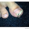 Toe ring